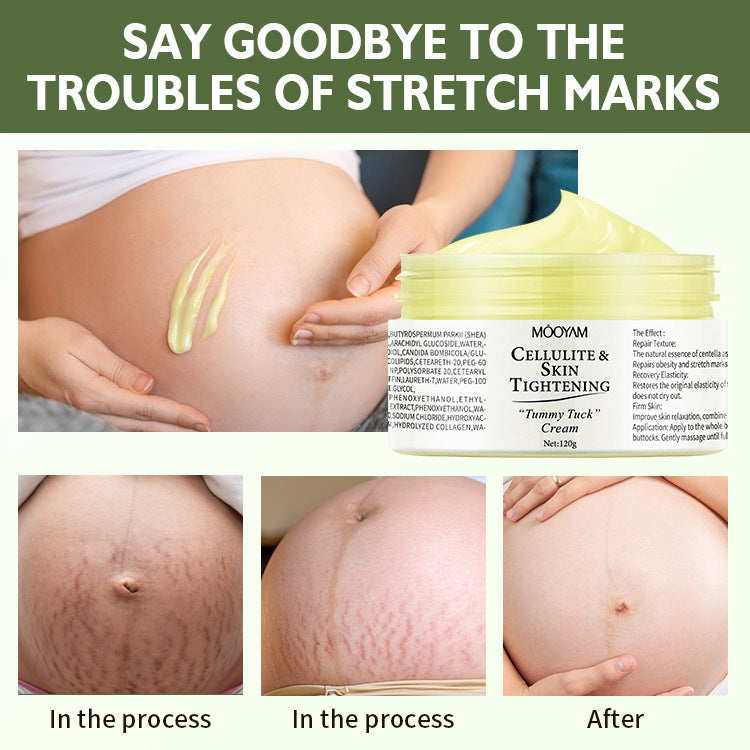 Stretch Mark Cream Fat Body Pattern Recovery Cream 0c5dd0ee 9865 49db 9cce 2e806009f684