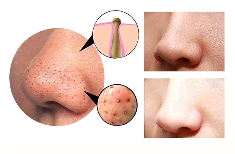 4 in 1 Body Guasha Cupping Blackhead Remover Machine Facial Pore Deep Cleansing Beauty Skin Care - HD Wireless Product #5