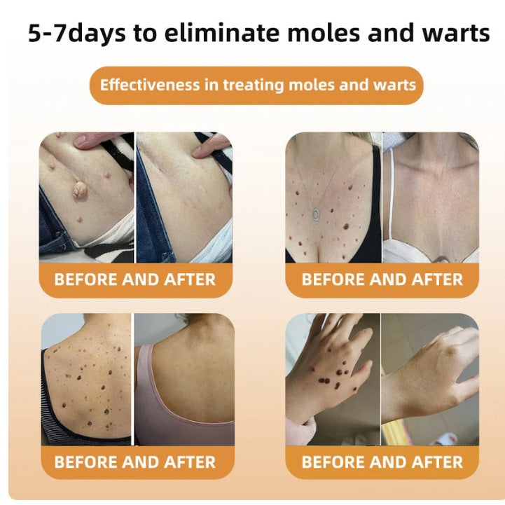 Mole And Wart Body Cream Fade Skin Cleaning 5d73a04b e3ef 4b65 bbc0 05f4092657a2
