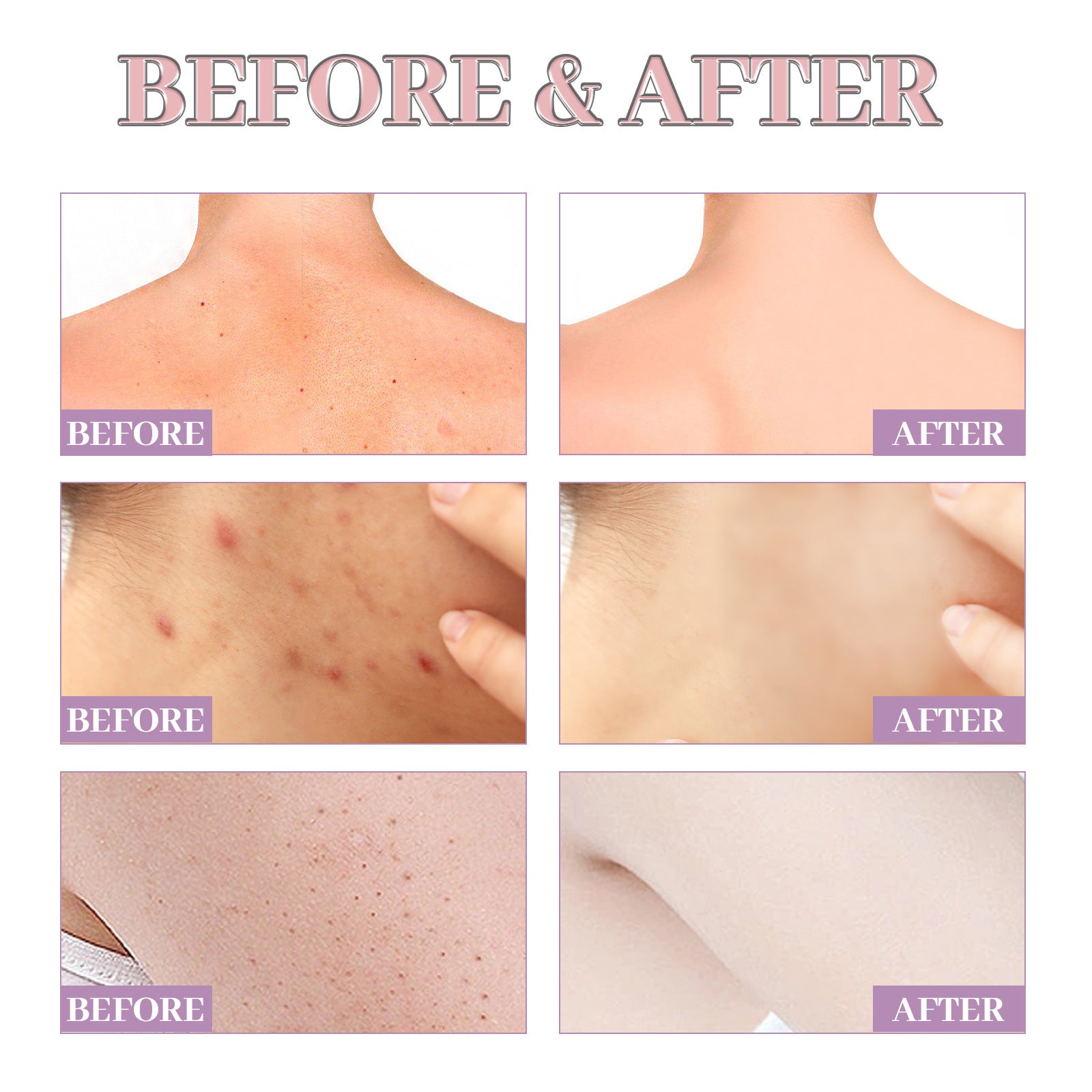 Chest Back Cleansing Fade Acne Print Skin Care Ball 058d5556 7af9 4fcf a226 68bb9d400b84