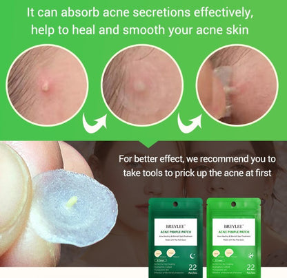 Tea Tree Acne Patch Fades Acne Marks and Ultra-thin 1346070252969