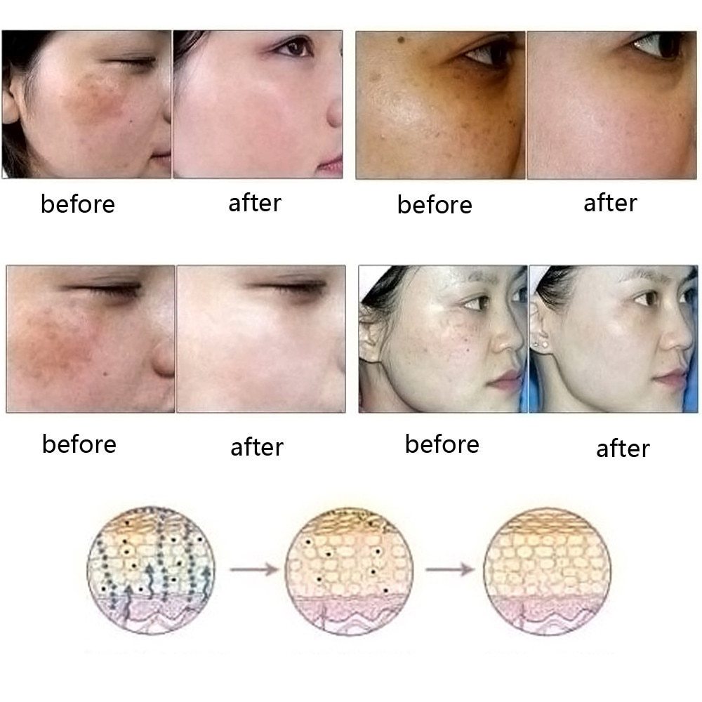 Dredge Meridian Skin Care Natural Pure Removal Acne Stretch Marks Scar Removal Essence oil 1768544549010