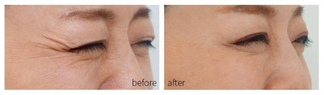 Household facial mask photon acne rejuvenation instrument 22974835714877