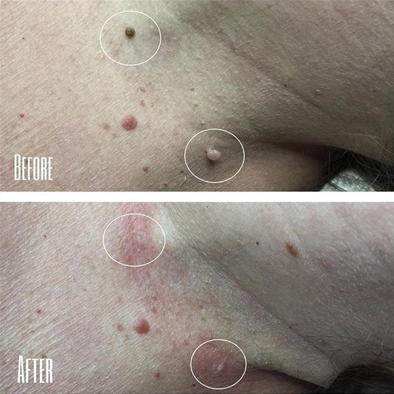 Moisturizing Facial Wart Remover 2401290900310323400