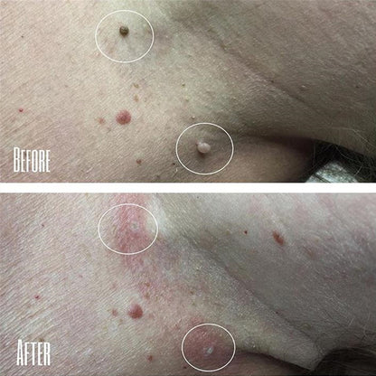 Moisturizing Facial Wart Remover 2401290900310323400