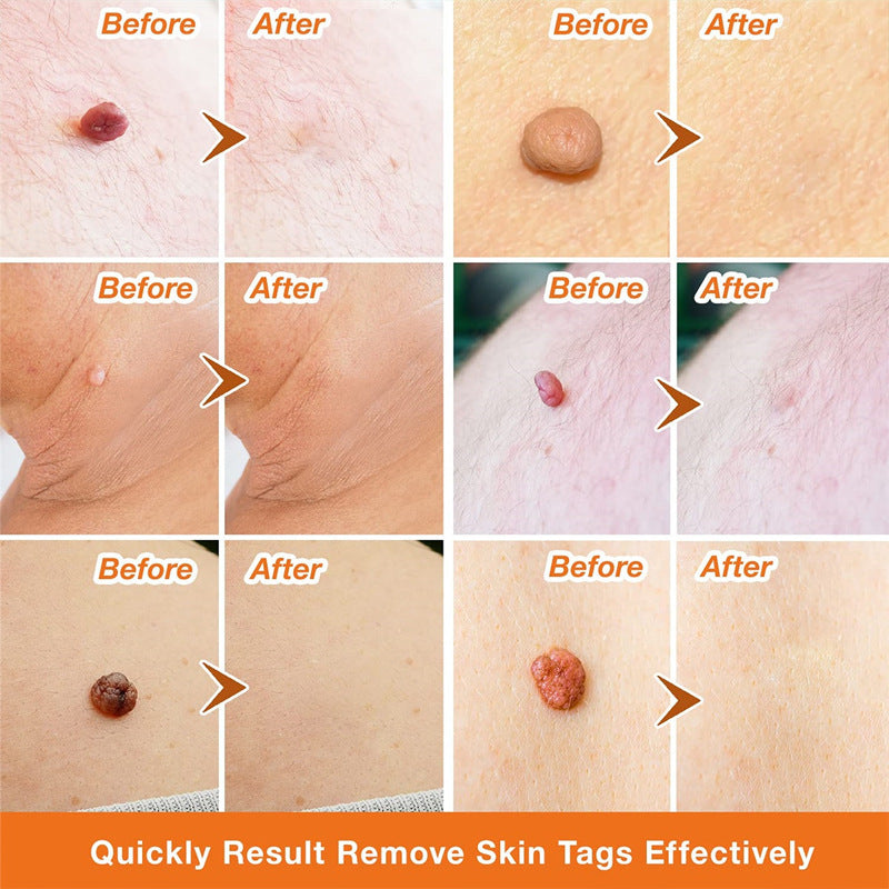 Moisturizing Facial Wart Remover 2401290900310325600