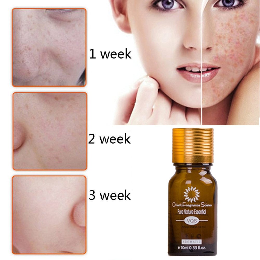 Dredge Meridian Skin Care Natural Pure Removal Acne Stretch Marks Scar Removal Essence oil 2737299980492