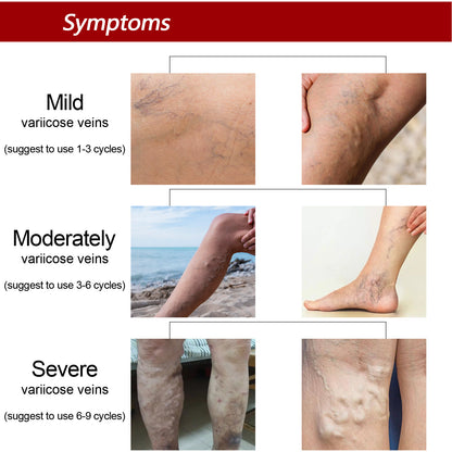 Earthworm Leg Vein Massage Cream For Relieving Leg Vascular Protrusion And Leg Swelling 40c2f0de 45d4 4b95 af23 7f50b80d6015