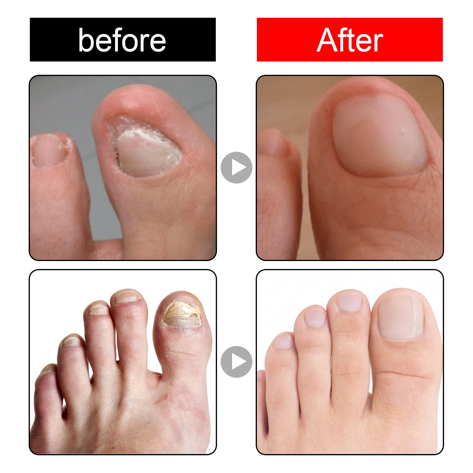 Endogenic Toenail Repair Nail Removal Essential Oil 4c1bf8f1 1b0c 45e4 b3c0 f18e0a9c2955