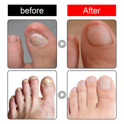 Endogenic Toenail Repair Nail Removal Essential Oil 4c1bf8f1 1b0c 45e4 b3c0 f18e0a9c2955