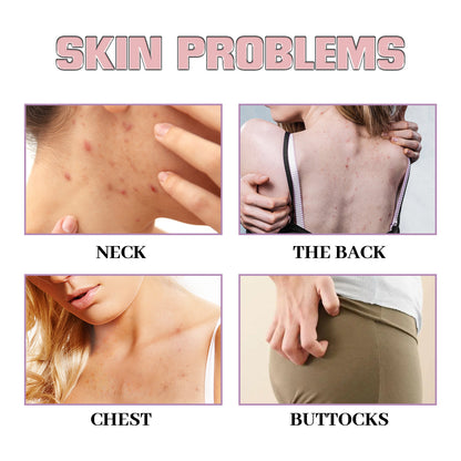 Chest Back Cleansing Fade Acne Print Skin Care Ball 4cb3dd5f f4e5 4e0f bff8 60b75480a2d8