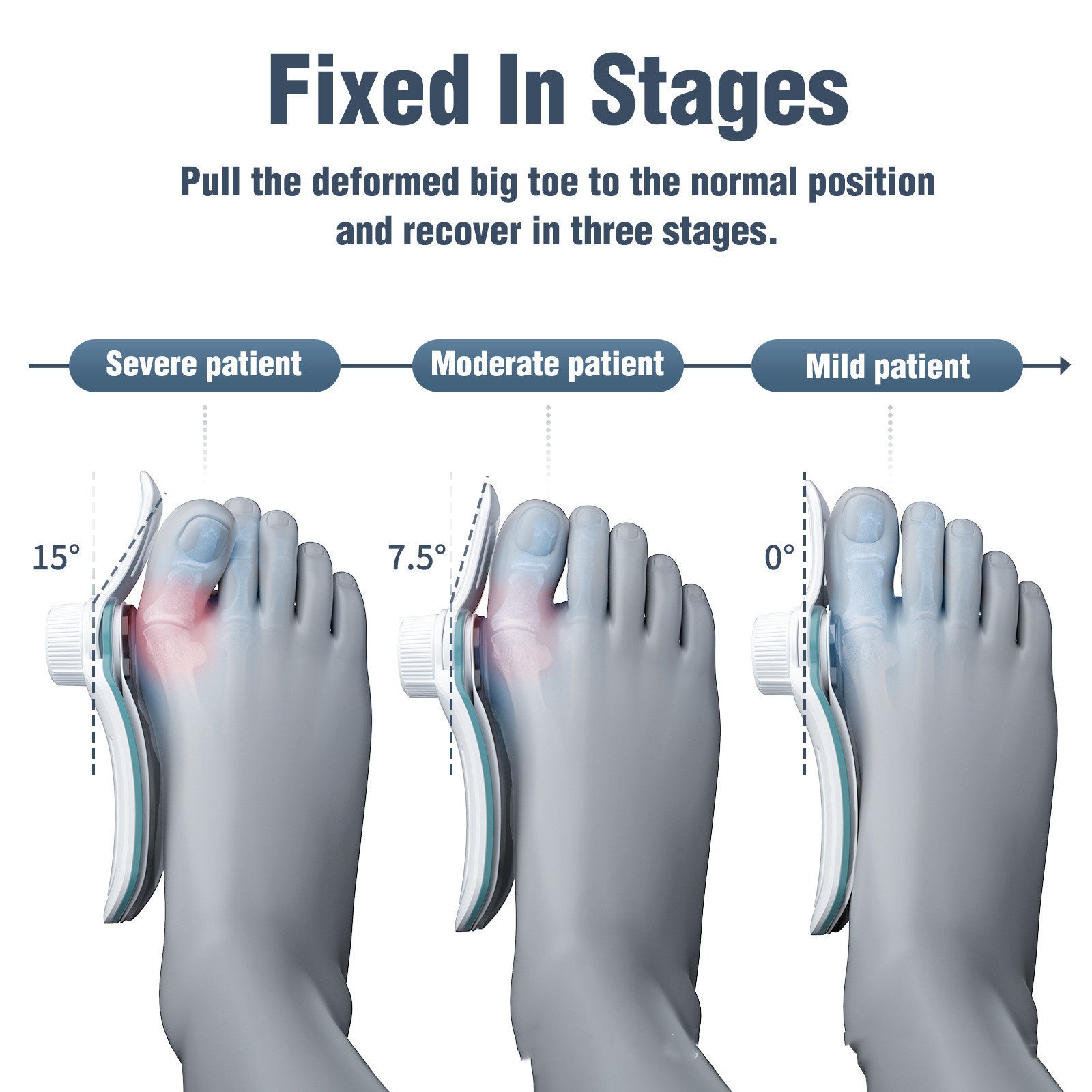 New Men's And Women's 3-board Correction Varying Degrees Thumb Valgus Orthosis 59170b5c 8e8c 4b63 817f fea3c00f5ddb