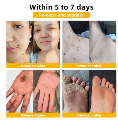 Mole And Wart Body Cream Fade Skin Cleaning 5d75e1ce 3694 4155 a211 0761e6ec5440