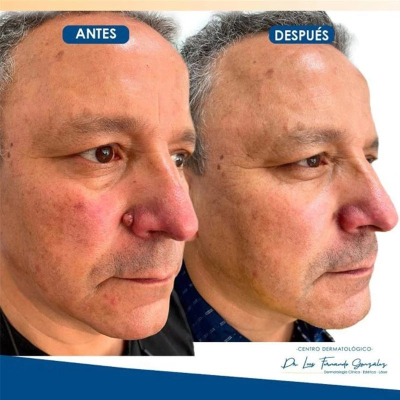Moisturizing Facial Wart Remover 68ef5bd5 d0de 435c ae95 be0e4e010849