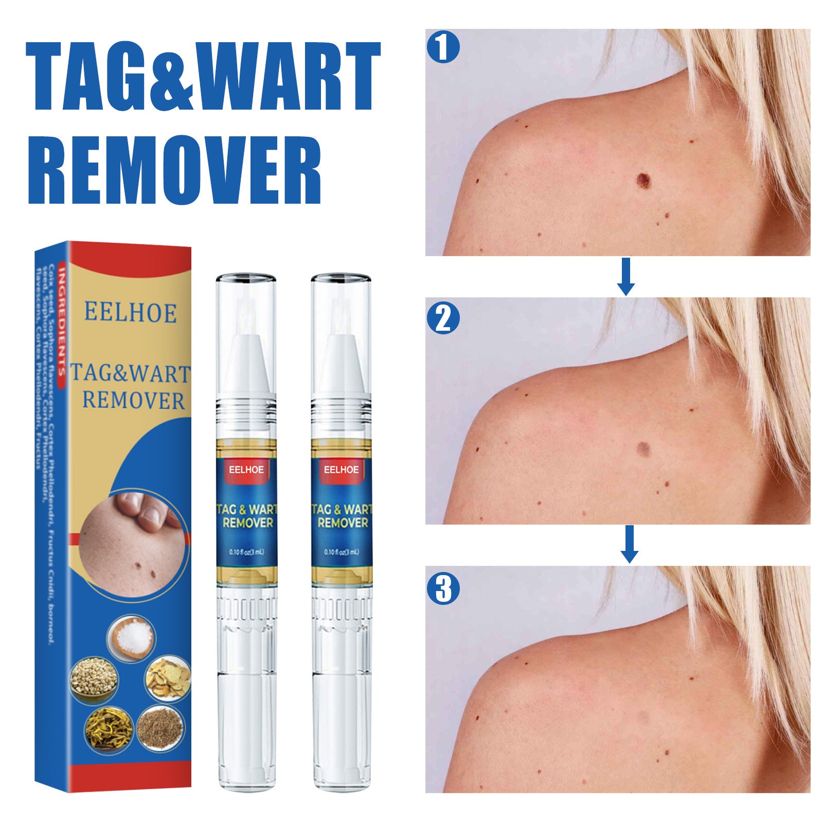 Skin Remove Nevus Pen To Liquid Body Skin Tags 6e20049b a2b7 4dcd a0f4 a598ef6c25a0