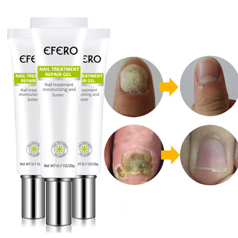 Nail Treatment Serum Nail Foot Nail Fungus Removal Gel Anti Infection Onychomycosis Nail Repair Cream Feet Care 7ea0435e e2fe