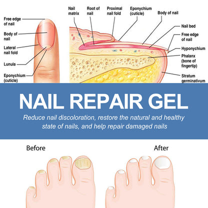 Nail Fungus Care Gel Repair a928ef70 8066 4c3c b89f da59357defb9