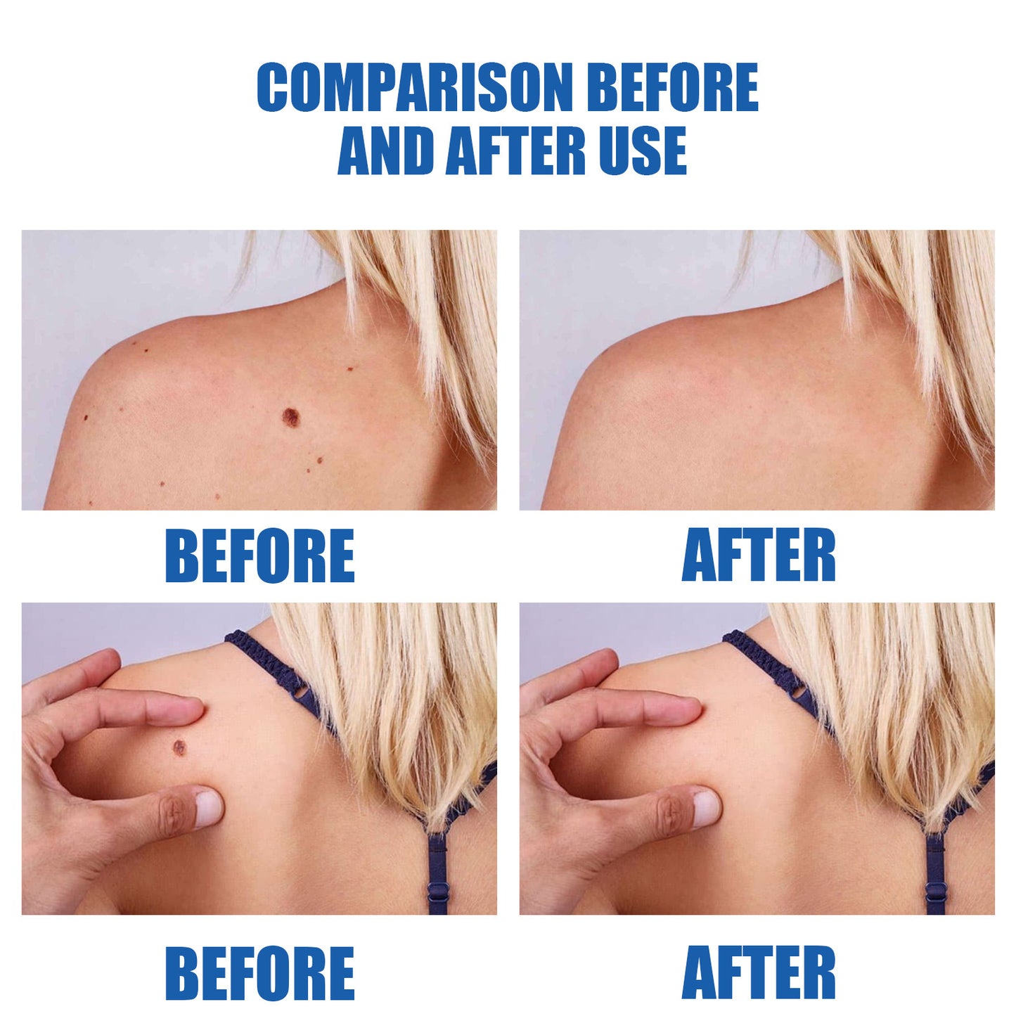 Skin Remove Nevus Pen To Liquid Body Skin Tags aa01448c d2c6 4d0a b986 99a919a27b07