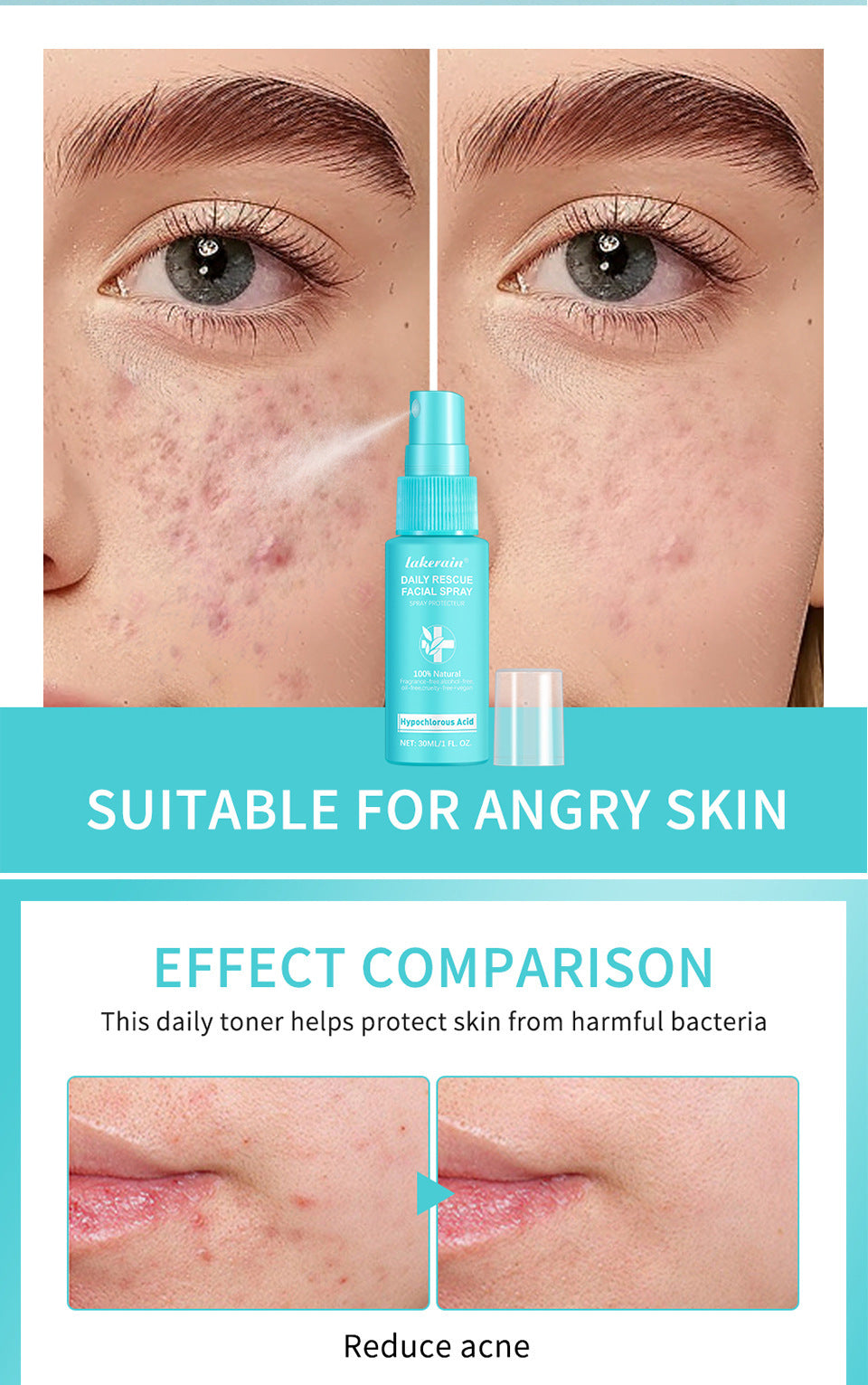Lakerain Facial First Aid Spray Hypochlorous Skin aa230639 35d5 4576 bc06 4a1c18a6847b