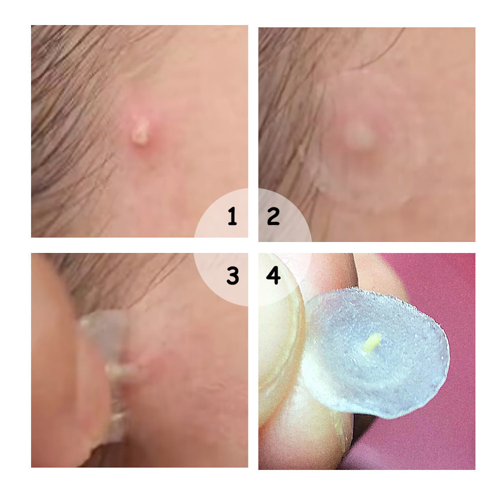 Acne Patch Daily Ultra-thin 01mm b819943f 5174 4dd3 af5f cadabe198134