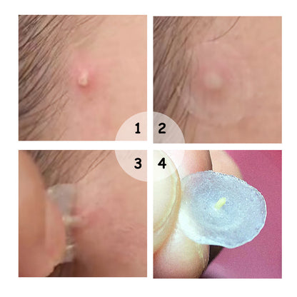 Acne Patch Daily Ultra-thin 01mm b819943f 5174 4dd3 af5f cadabe198134
