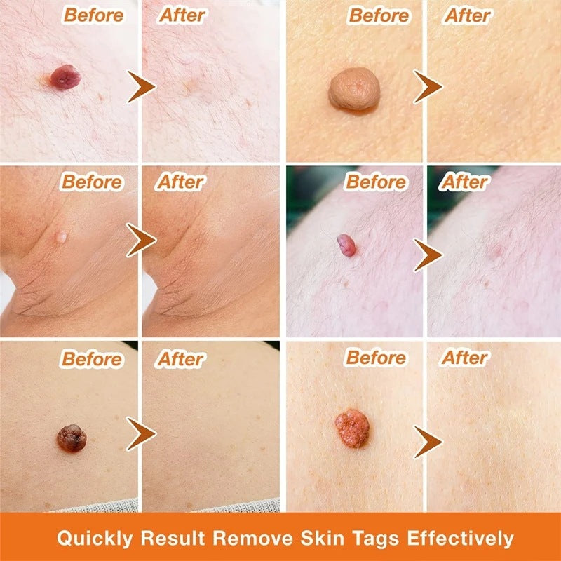 Moisturizing Facial Wart Remover cf7d5ba3 e63a 4f34 9798 c175628352ac