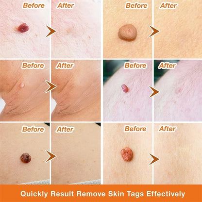 Moisturizing Facial Wart Remover cf7d5ba3 e63a 4f34 9798 c175628352ac