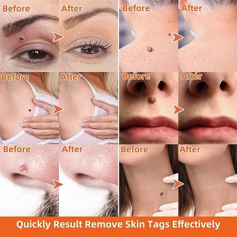 Moisturizing Facial Wart Remover d7798573 b9b6 4fcc a0e9 d1911834fbab